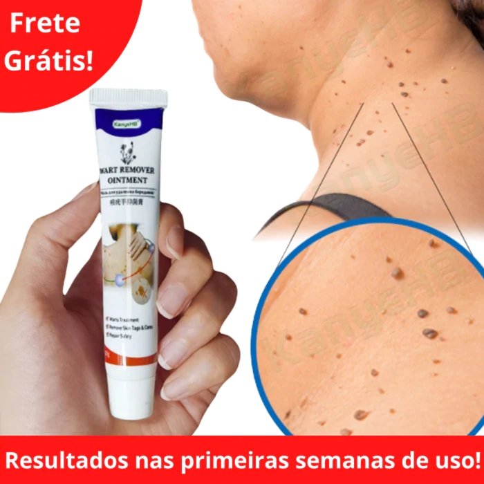 SomeVerrugas! - Creme de tratamento de verrugas + EBOOK GRÁTIS - Mania das CoisasSomeVerrugas! - Creme de tratamento de verrugas + EBOOK GRÁTISMania das Coisas